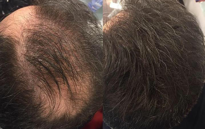 Tipos de Doenças Capilares do Couro Cabeludo - Tratamento para Queda de cabelo
