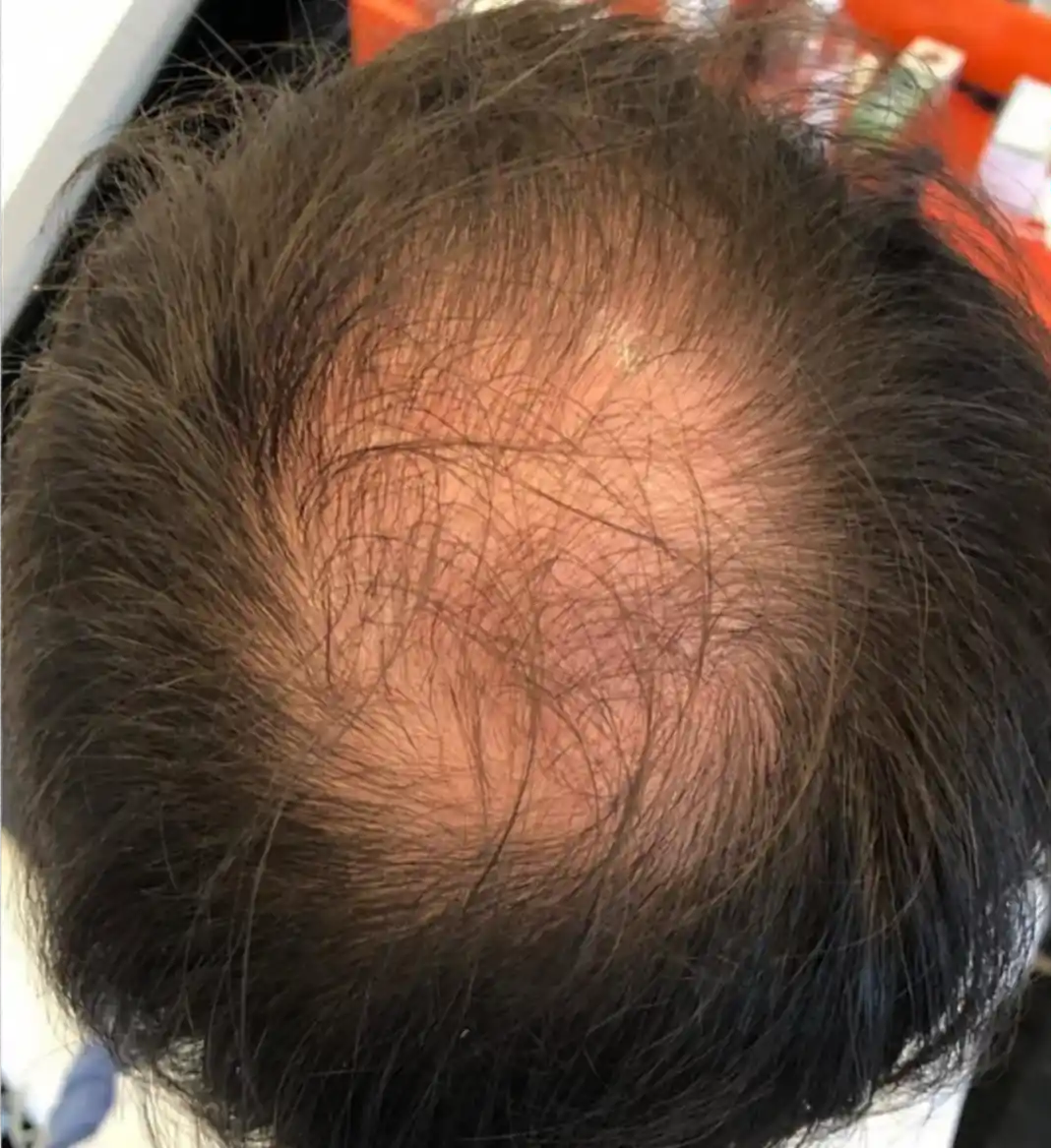 Alopecia androgenética masculina antes do tratamento