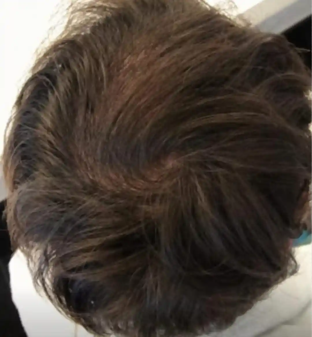 Alopecia androgenética masculina depois do tratamento