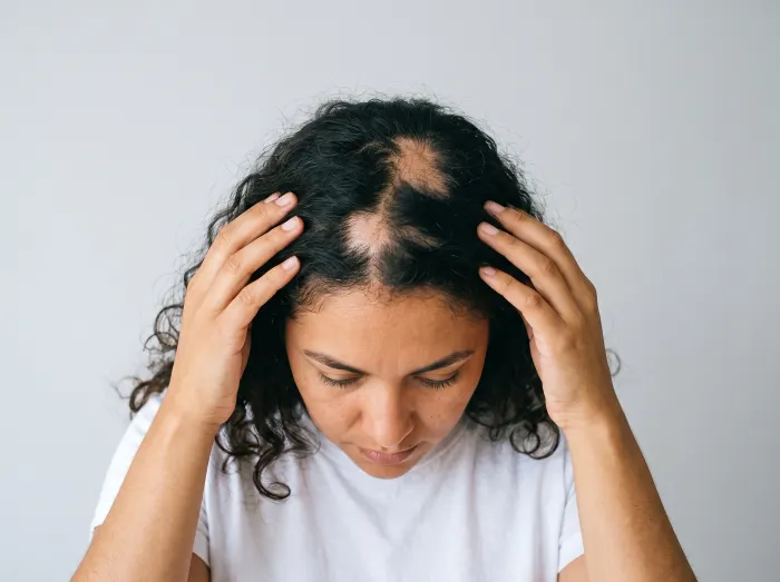 Alopecia areata com falhas no cabelo