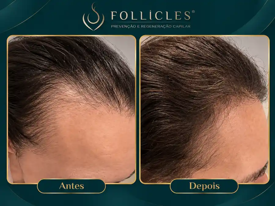 Comparativo de antes e depois — paciente do sexo feminino, Follicles 1