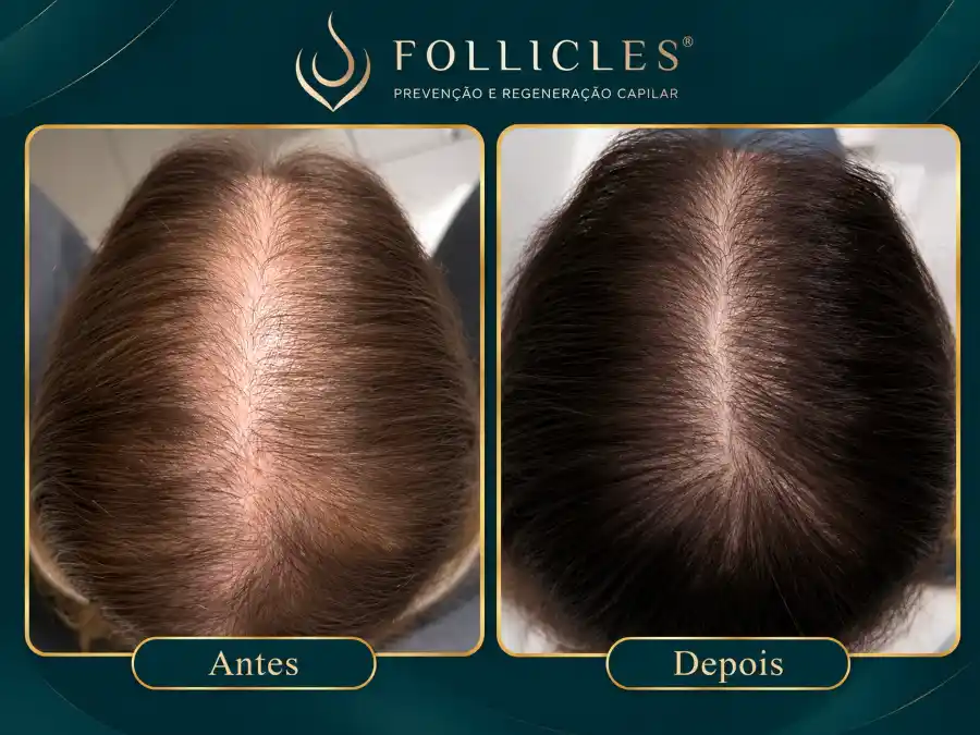 Comparativo de antes e depois — paciente do sexo feminino, Follicles 2