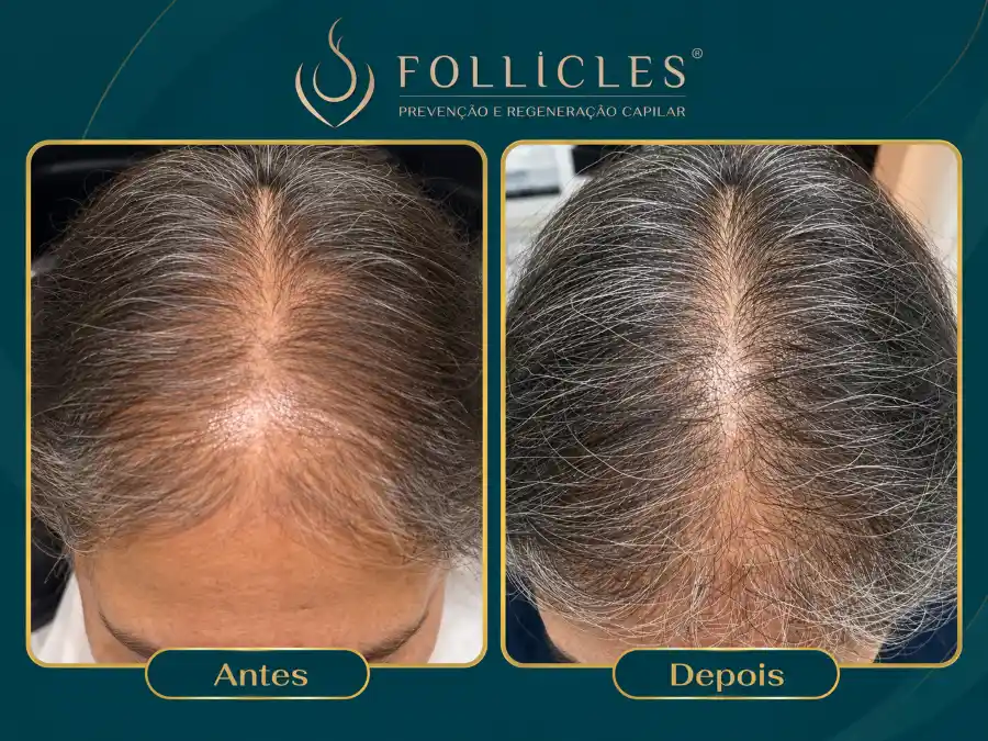 Comparativo de antes e depois — paciente do sexo feminino, Follicles 3