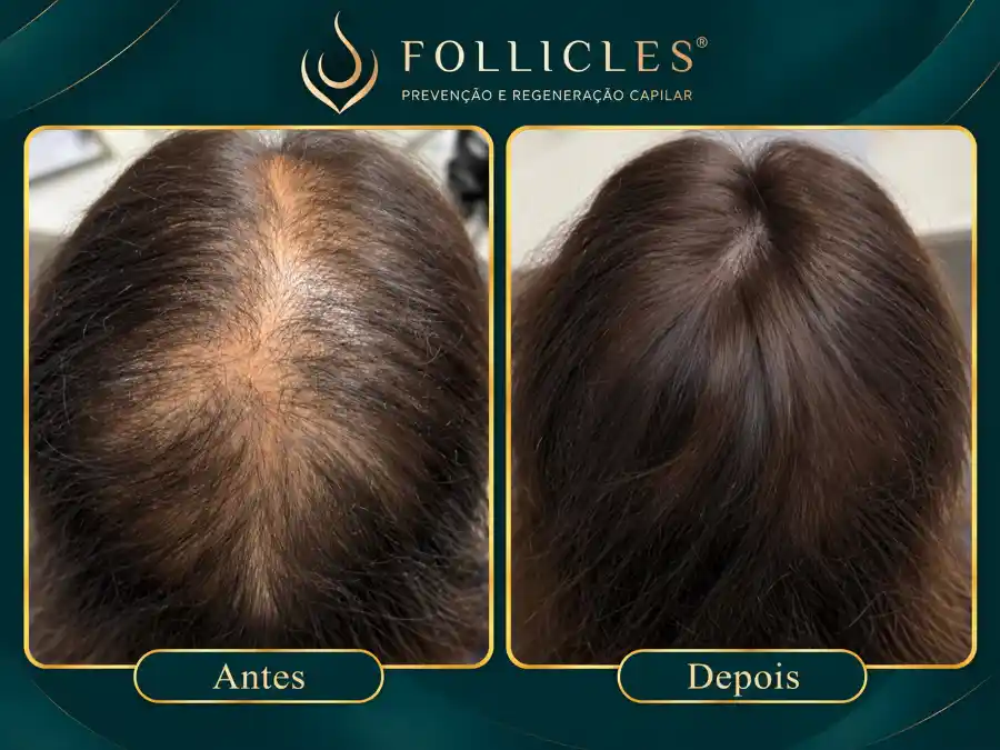 Comparativo de antes e depois — paciente do sexo feminino, Follicles 5