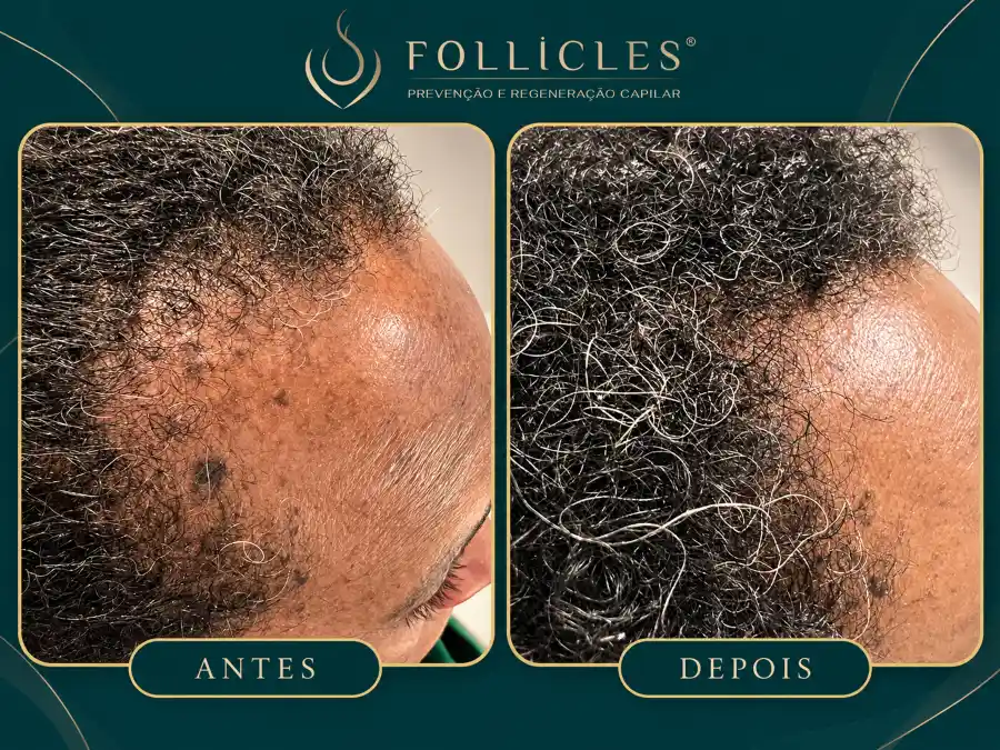 Comparativo de antes e depois — paciente do sexo masculino, Follicles 1