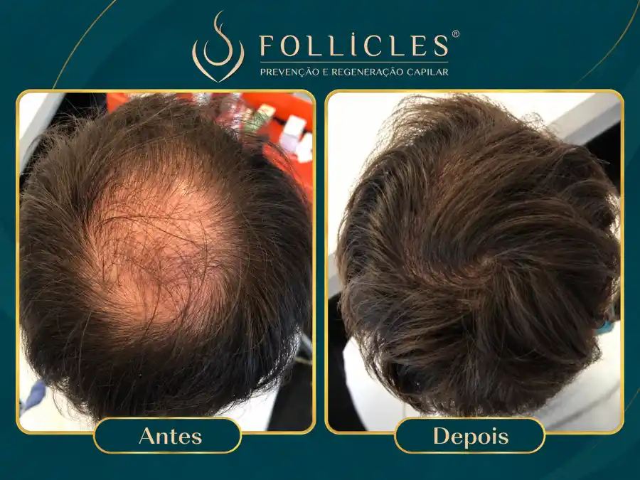 Comparativo de antes e depois — paciente do sexo masculino, Follicles 2