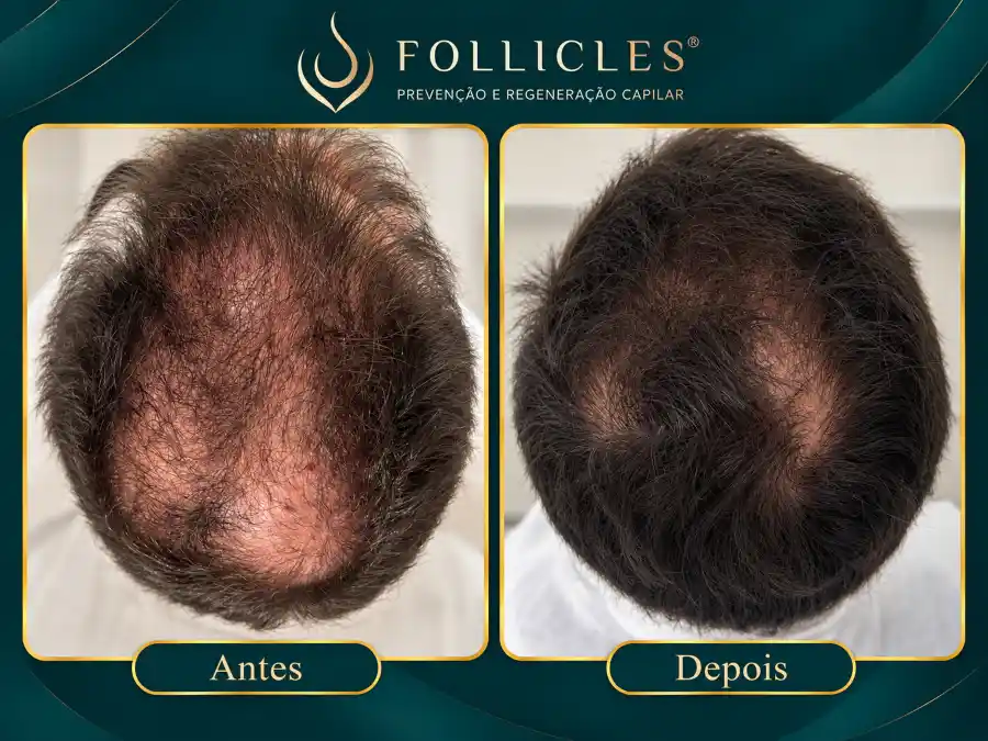 Comparativo de antes e depois — paciente do sexo masculino, Follicles 3