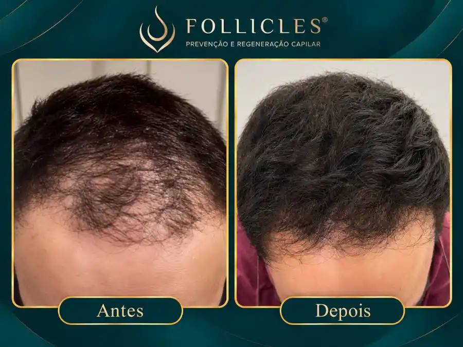 Comparativo de antes e depois — paciente do sexo masculino, Follicles 4