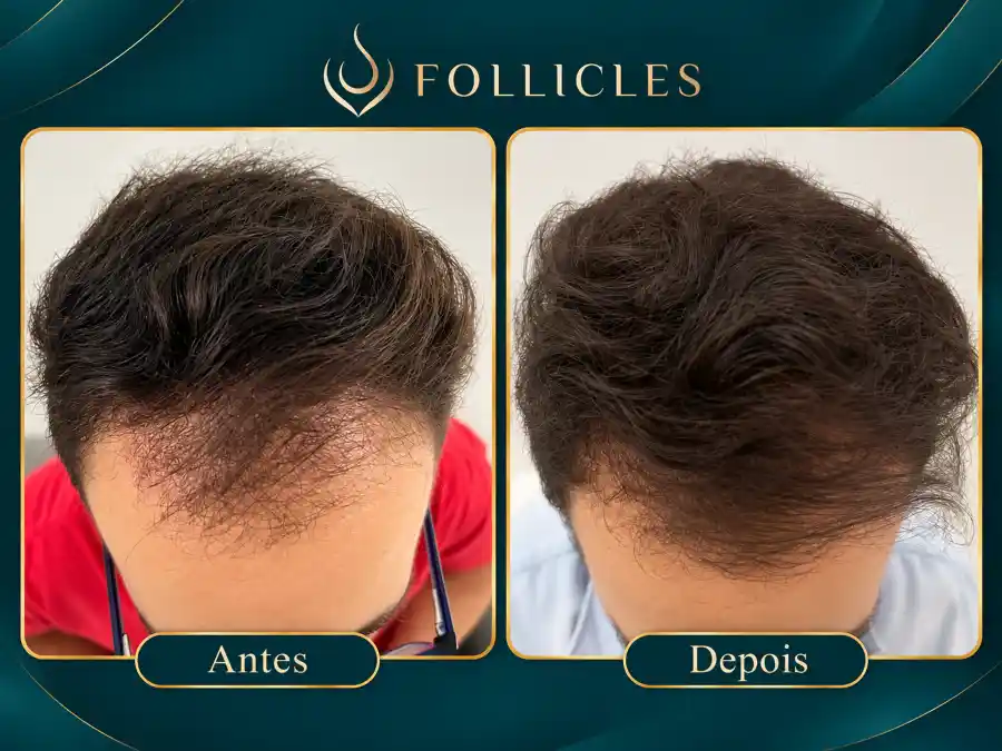 Comparativo de antes e depois — paciente do sexo masculino, Follicles 5