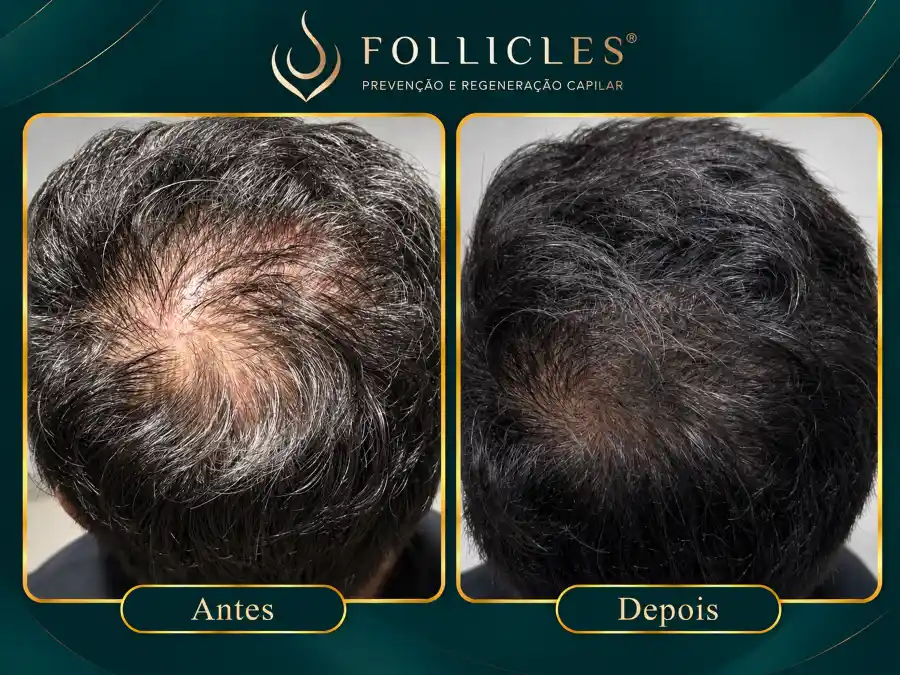 Comparativo de antes e depois — paciente do sexo masculino, Follicles 6