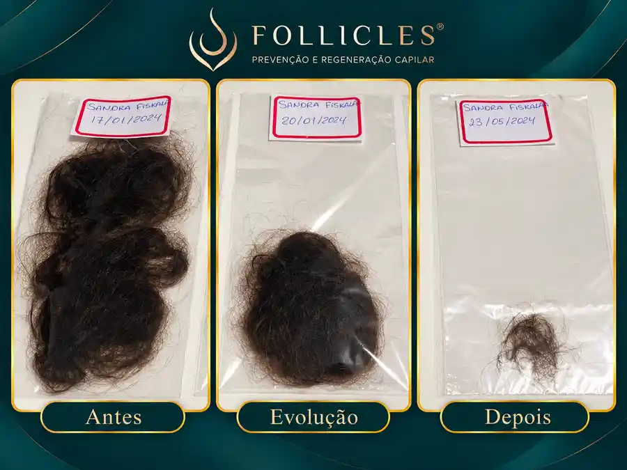 Teste de tração — avaliação de queda capilar na Clínica Follicles