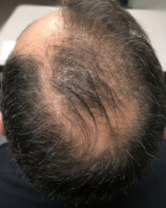 Alopecia androgenética feminina antes do tratamento