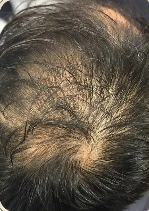 Alopecia androgenética masculina na coroa antes do tratamento