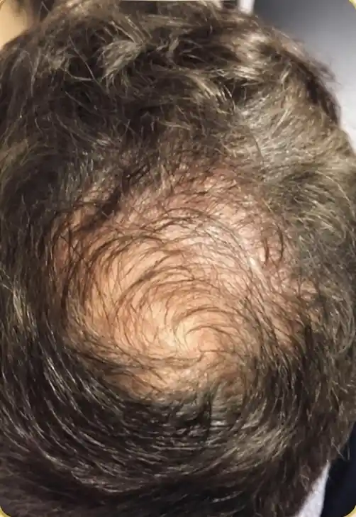 Queda de cabelo antes do tratamento