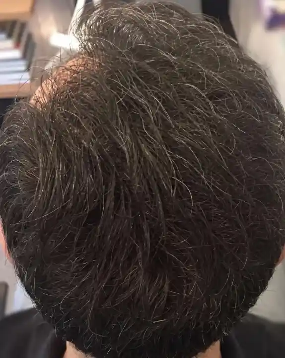 Alopecia androgenética feminina depois do tratamento