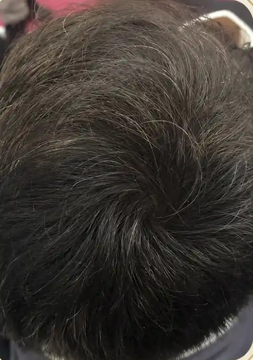 Alopecia androgenética masculina na coroa depois do tratamento