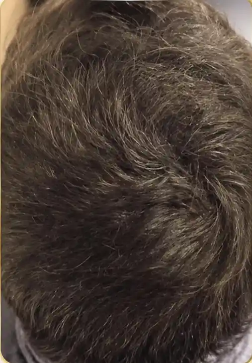 Queda de cabelo depois do tratamento