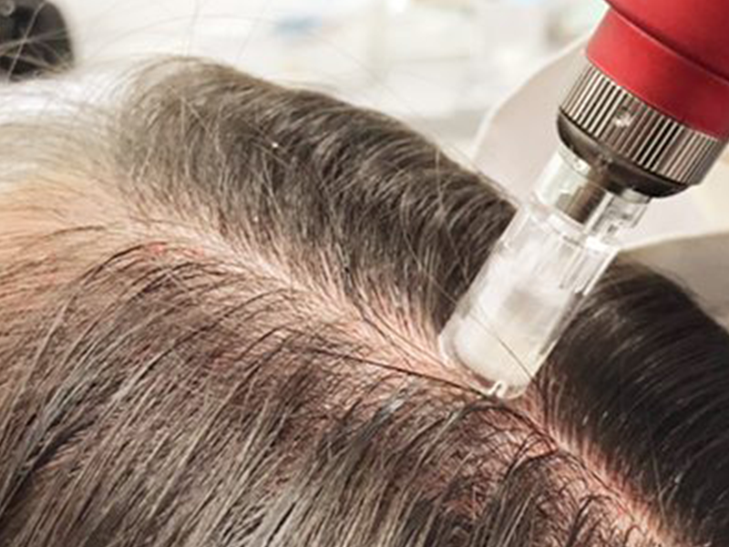 Microagulhamento Capilar em São Paulo, Morumbi - Clínica Follicles