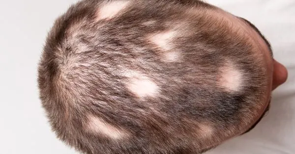 Micose do couro cabeludo em crianças (tinea capitis): Qual é o melhor  tratamento?