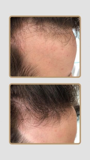 Resultado Tratamento Queda de Cabelo e Calvície
