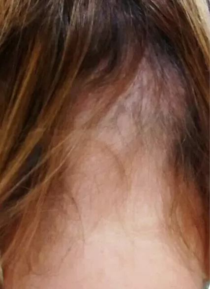ANTES - Resultado Tratamento Queda de Cabelo e Calvície