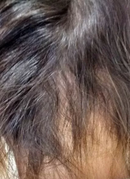 DEPOIS - Resultado Tratamento Queda de Cabelo e Calvície