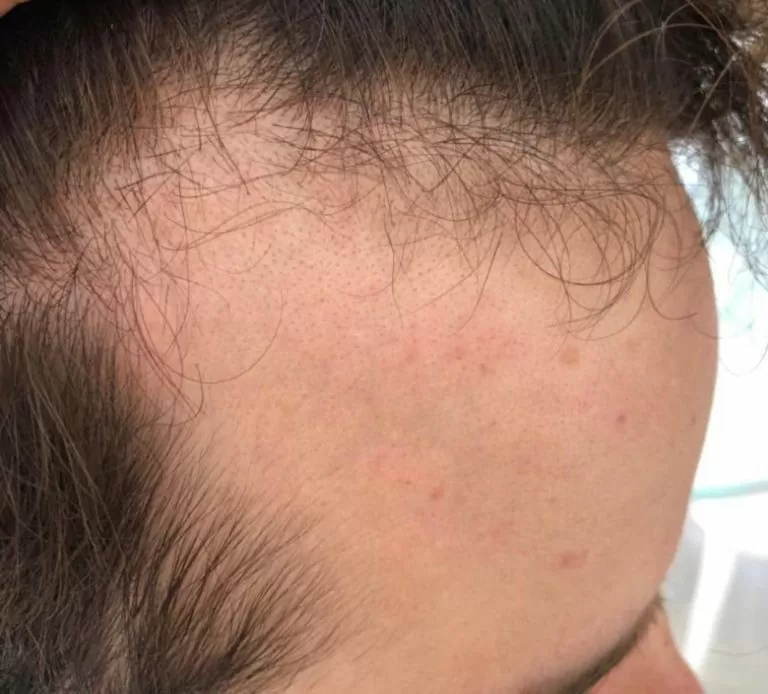 ANTES - Resultado Tratamento Queda de Cabelo e Calvície