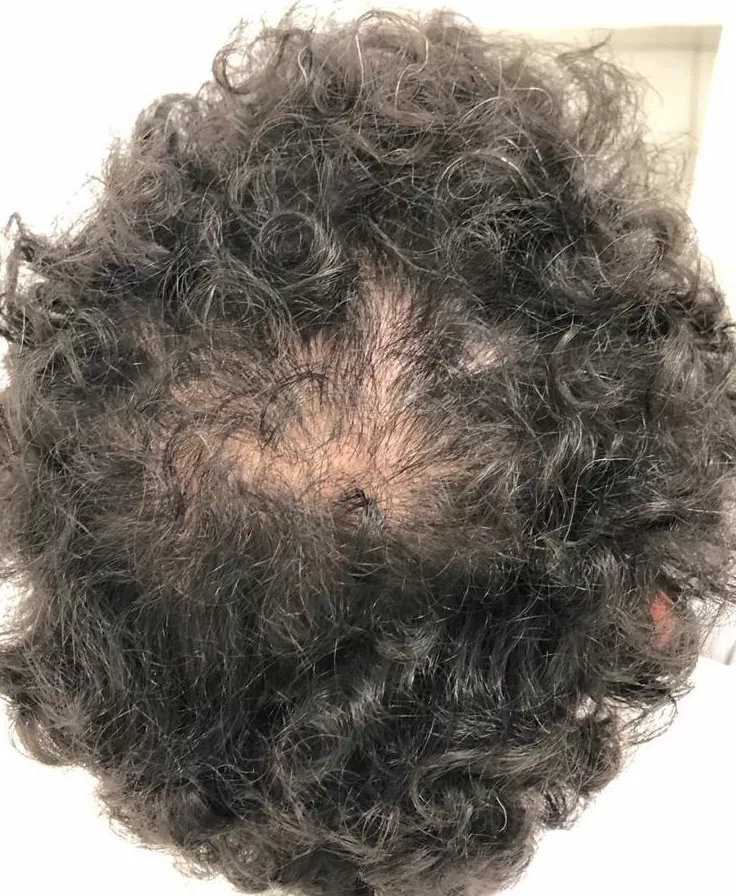 ANTES - Resultado Tratamento Queda de Cabelo e Calvície