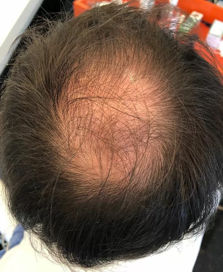 ANTES - Resultado Tratamento Queda de Cabelo e Calvície