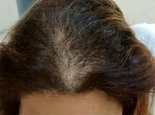 ANTES - Resultado Tratamento Queda de Cabelo e Calvície