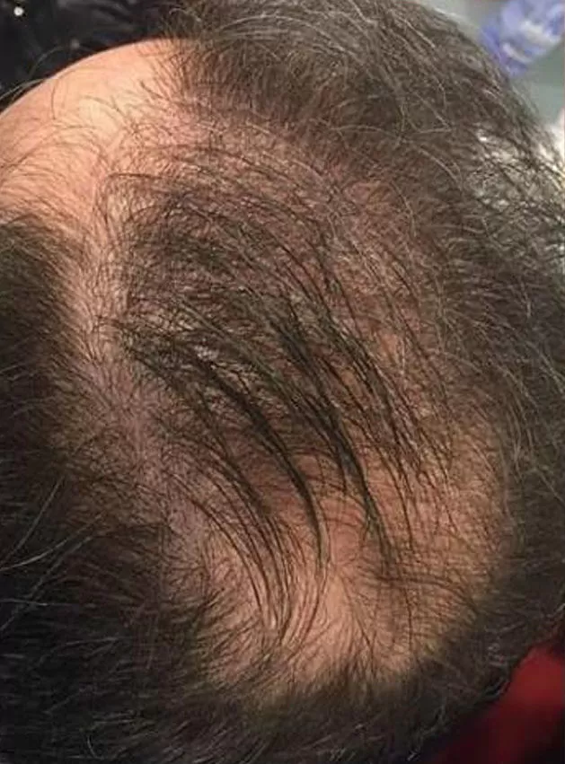 ANTES - Resultado Tratamento Queda de Cabelo e Calvície
