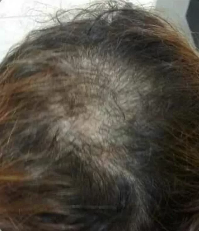 ANTES - Resultado Tratamento Queda de Cabelo e Calvície