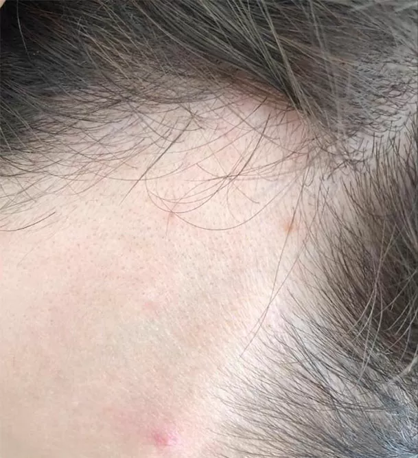 ANTES - Resultado Tratamento Queda de Cabelo e Calvície