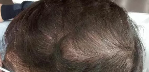 ANTES - Resultado Tratamento Queda de Cabelo e Calvície
