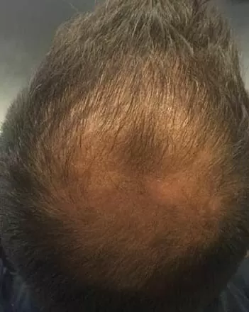 ANTES - Resultado Tratamento Queda de Cabelo e Calvície
