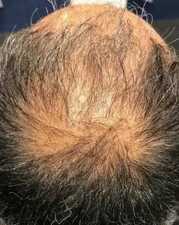 ANTES - Resultado Tratamento Queda de Cabelo e Calvície