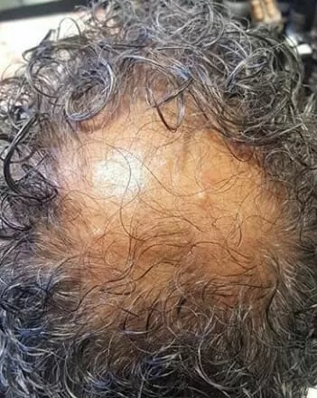 ANTES - Resultado Tratamento Queda de Cabelo e Calvície