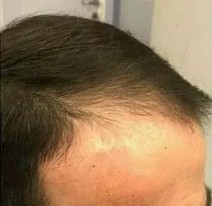 ANTES - Resultado Tratamento Queda de Cabelo e Calvície
