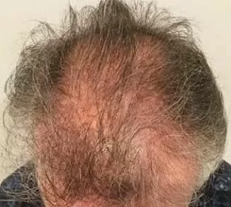ANTES - Resultado Tratamento Queda de Cabelo e Calvície
