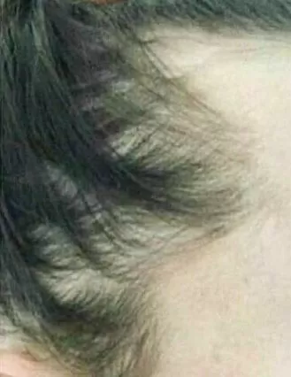 ANTES - Resultado Tratamento Queda de Cabelo e Calvície