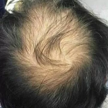 ANTES - Resultado Tratamento Queda de Cabelo e Calvície