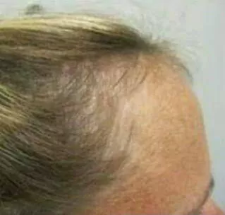 ANTES - Resultado Tratamento Queda de Cabelo e Calvície