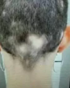ANTES - Resultado Tratamento Queda de Cabelo e Calvície