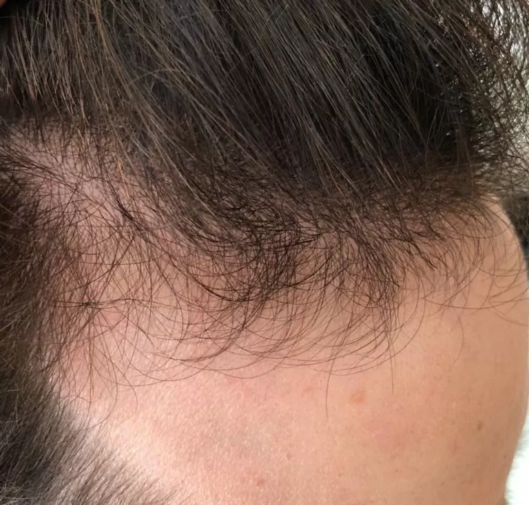 DEPOIS - Resultado Tratamento Queda de Cabelo e Calvície