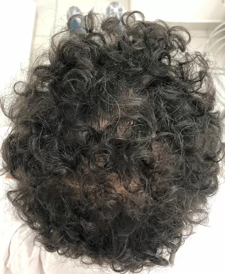 DEPOIS - Resultado Tratamento Queda de Cabelo e Calvície
