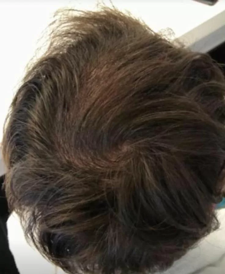 DEPOIS - Resultado Tratamento Queda de Cabelo e Calvície