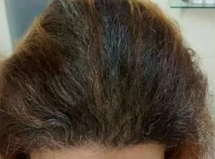 DEPOIS - Resultado Tratamento Queda de Cabelo e Calvície