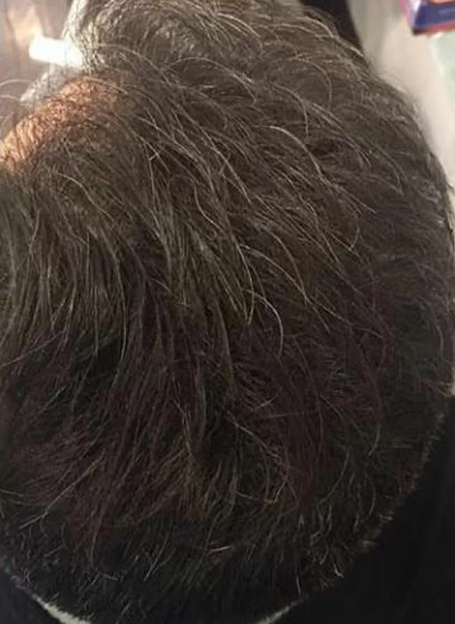 DEPOIS - Resultado Tratamento Queda de Cabelo e Calvície