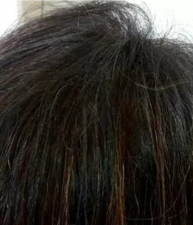 DEPOIS - Resultado Tratamento Queda de Cabelo e Calvície