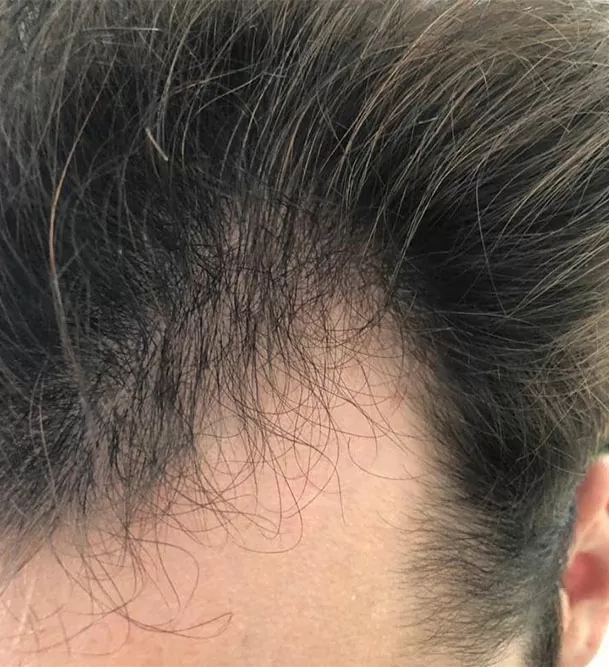 DEPOIS - Resultado Tratamento Queda de Cabelo e Calvície